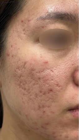 상호 변경 전 동일 의료기관 여성 복합 패인 흉터 증례의 치료 전 사진