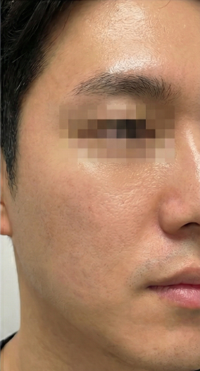 상호 변경 전 동일 의료기관 남성 여드름 흉터와 모공 증례의 치료 후 사진