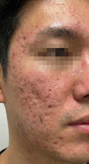 상호 변경 전 동일 의료기관 남성 여드름 흉터와 모공 증례의 치료 전 사진
